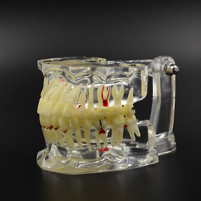 Dental Study Teeth Model Transparent Adult Pathological Disease Tooth Dentistry