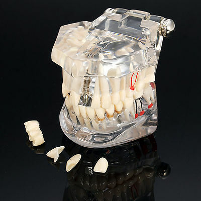 Dental Implant Disease Study Teaching Teeth Model With Restoration&bridge Tooth
